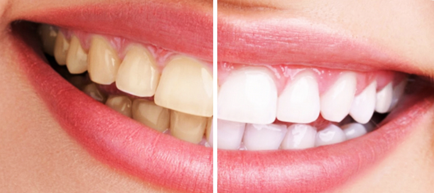 10 dudas frecuentes sobre el blanqueamiento dental